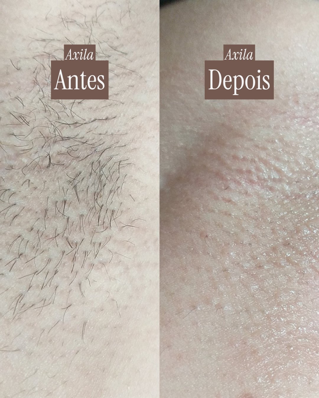 Antes e depois da epilação da axila